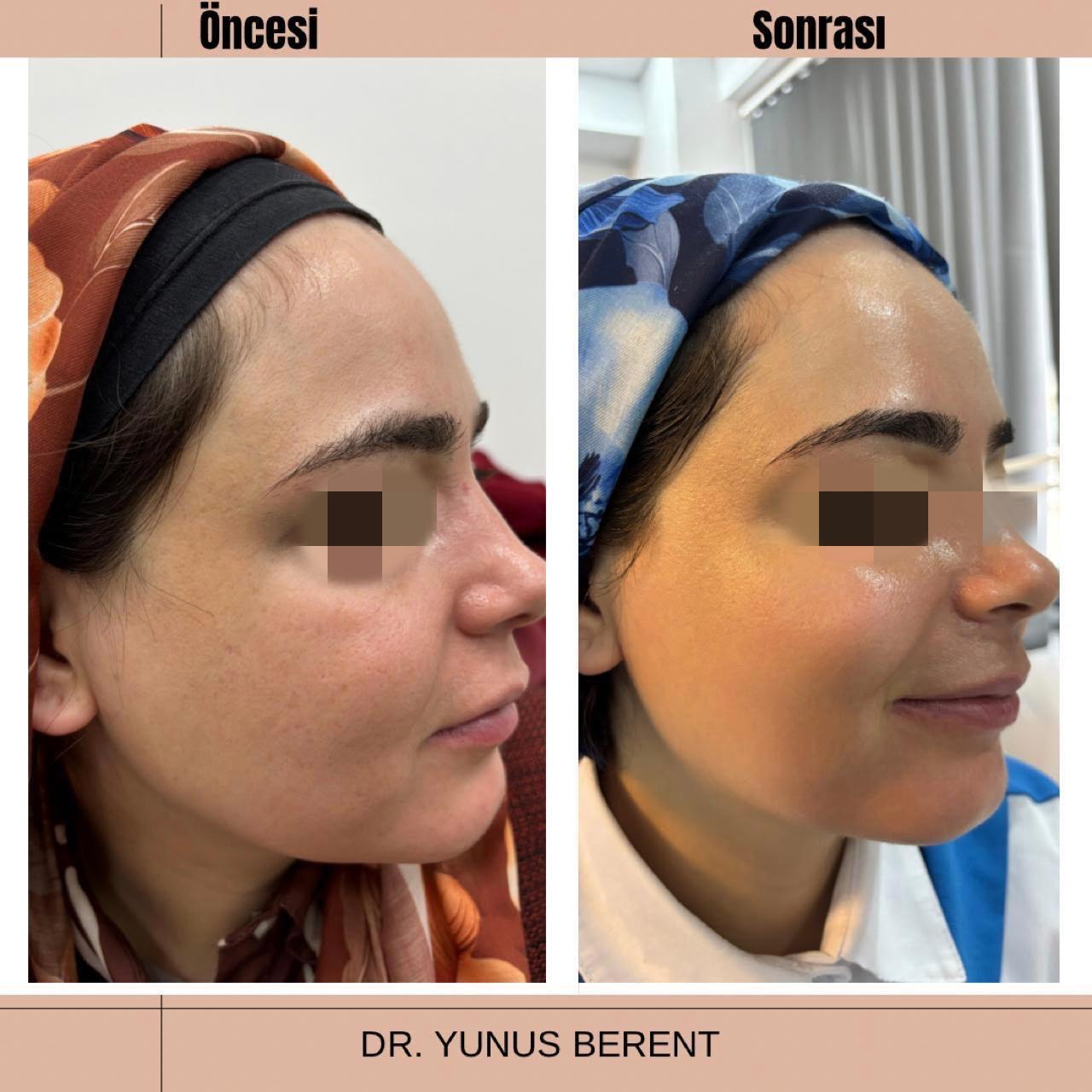 Viranşehir Scarlet X altın iğne uygulaması