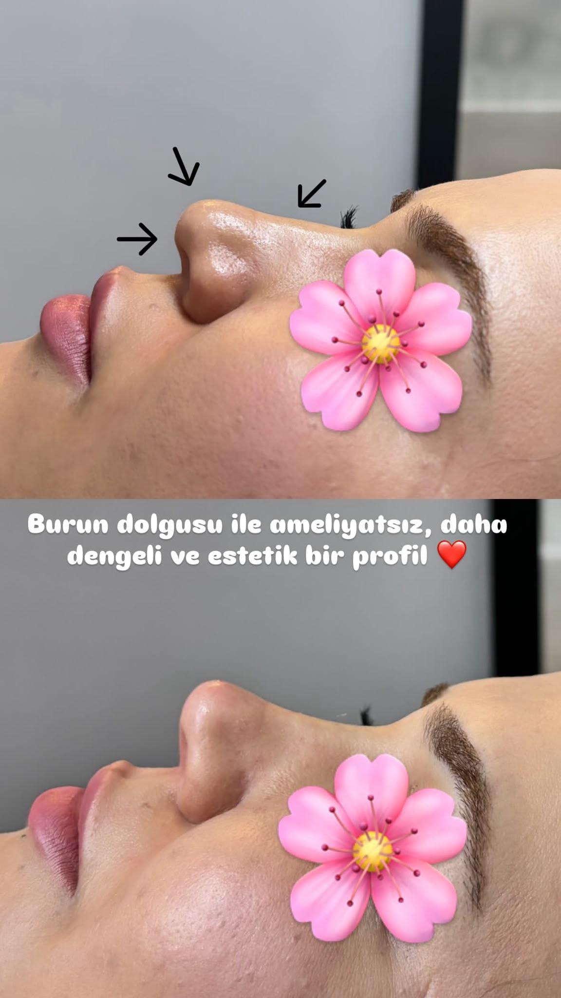 Viranşehir burun dolgusu uygulaması — ameliyatsız burun profili